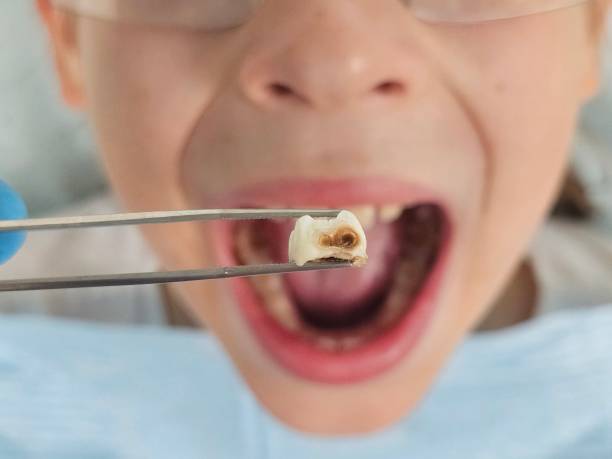 Best Chipped Tooth Repair Near Me  in Mamou, LA